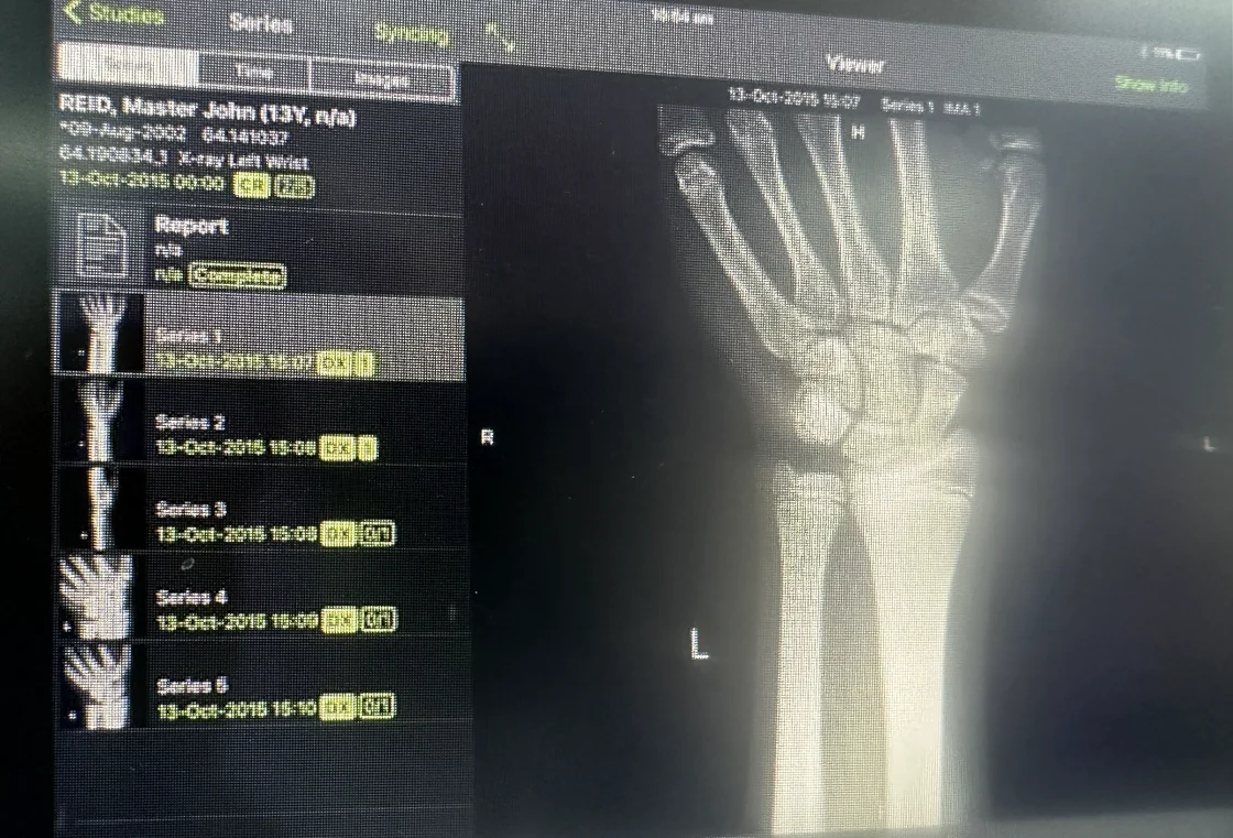 A photograph of a radiology workstation showing a wrist X-ray beside a study panel of patient and study details.